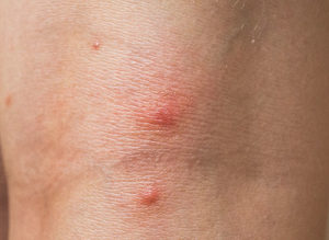 Bed Bug Bites Picture On Knee