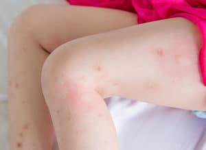 Image Of Bed Bug Bites