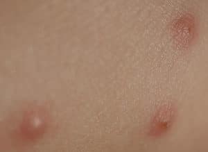 Image Of Bedbug Bites