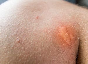 Picture Of Bedbug Bite On Knee